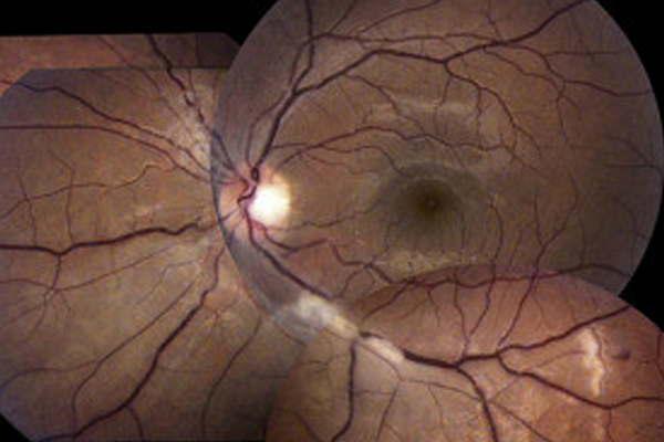 iquestQueacute es la oclusioacuten de rama venosa de la retina