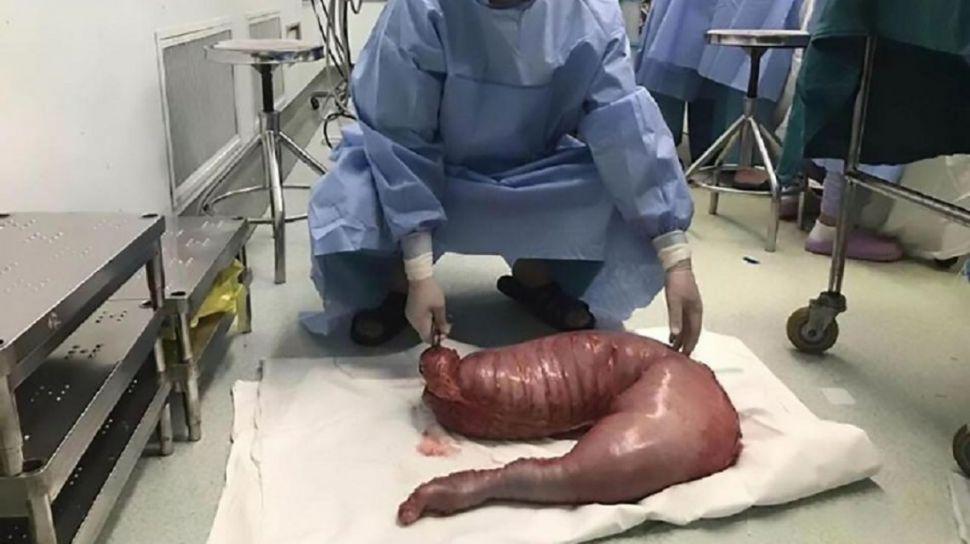 Estuvo 20 antildeos constipado y le extirpan un suacuteper intestino