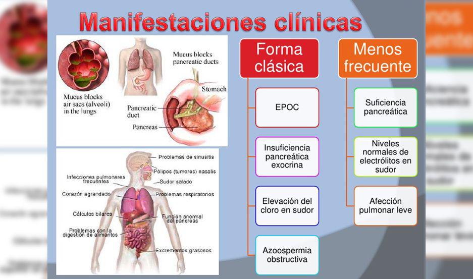 Promueven la sancioacuten de una ley en favor de pacientes con fibrosis quiacutestica en el paiacutes