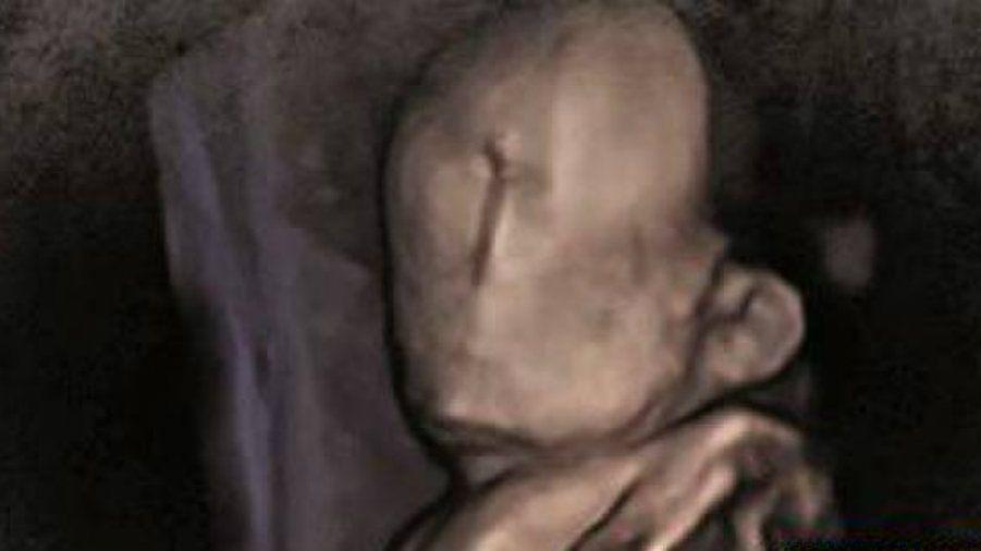 La conmovedora historia de un bebeacute que nacioacute sin rostro en Portugal