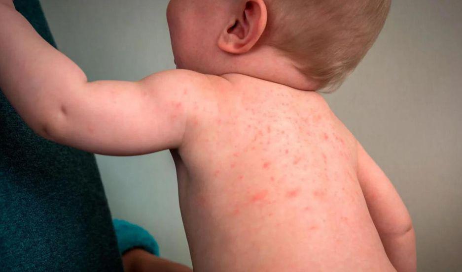 Confirman 44 casos de sarampioacuten en el paiacutes y reiteran la necesidad de vacunar a los chicos