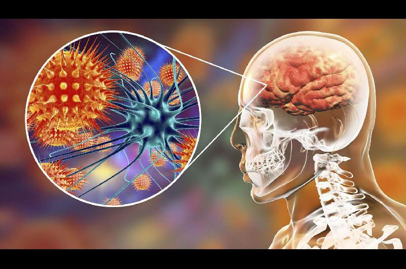 La meningitis bacteriana tiene una alta tasa de mortalidad