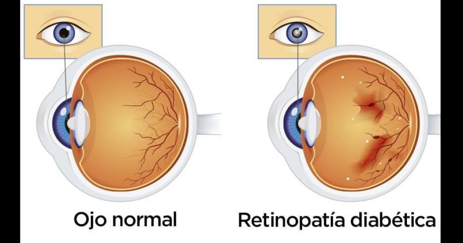 Es posible preservar la salud ocular aun teniendo diabetes