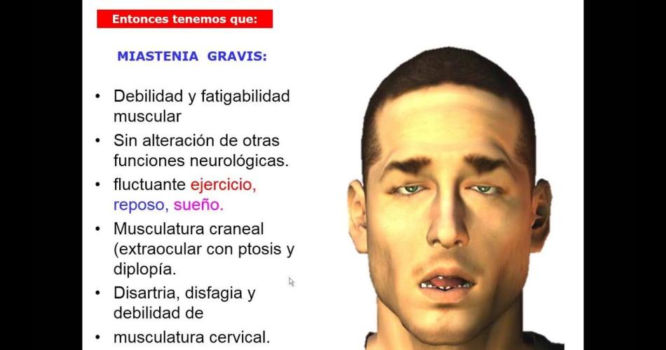 Miastenia Gravis- afeccioacuten poco frecuente con varios casos en Santiago