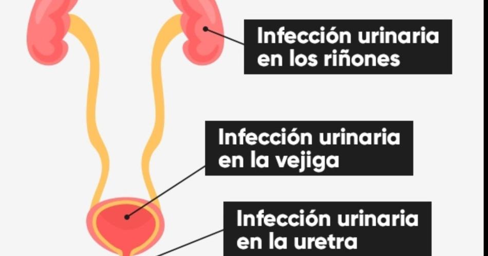 Infecciones urinarias- instan a prestar atencioacuten a los siacutentomas y no demorar la consulta meacutedica