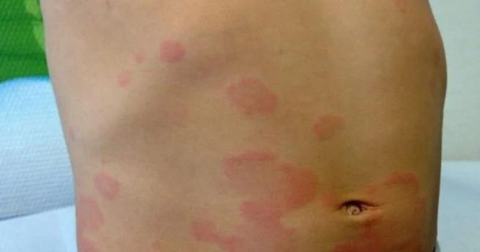 Especialistas aseguran que la urticaria croacutenica tiene un elevado impacto en la calidad de vida