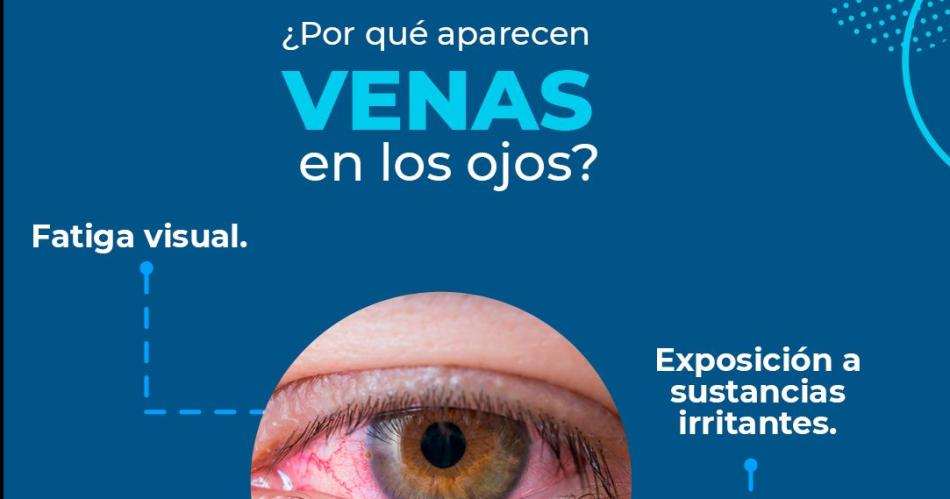 Venas rojas en los ojos iquestEs para preocuparse