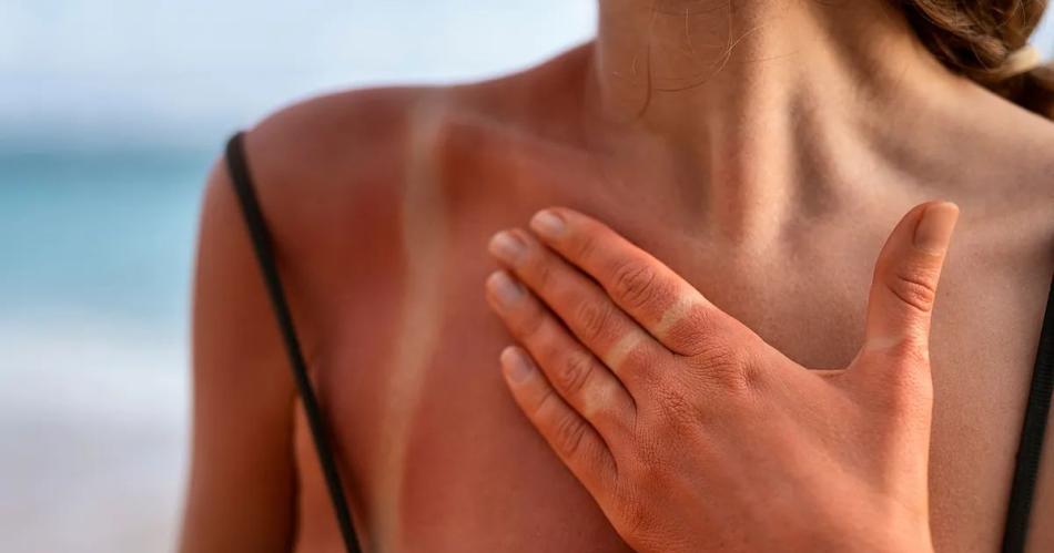 Caacutencer de piel- crecen los casos por exposicioacuten al sol y el uso indiscriminado de camas solares